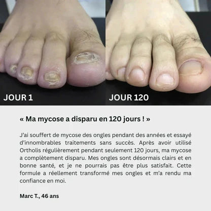 Gel contre les mycoses des ongles BF