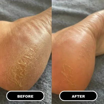 PR1 - Bâton à l'Urée Pieds Secs