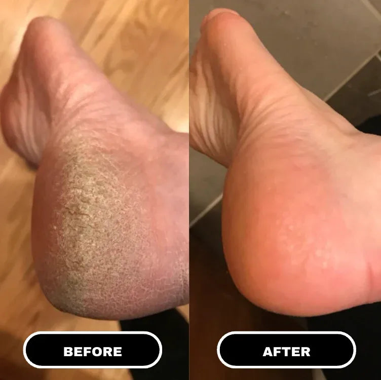 PR1 - Bâton à l'Urée Pieds Secs